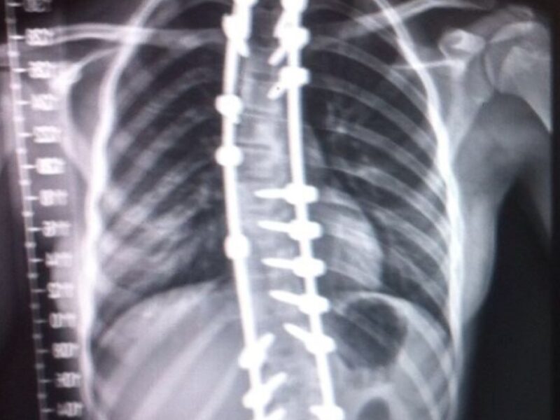 The image shows an x-ray of a spine with pins and clamps in.