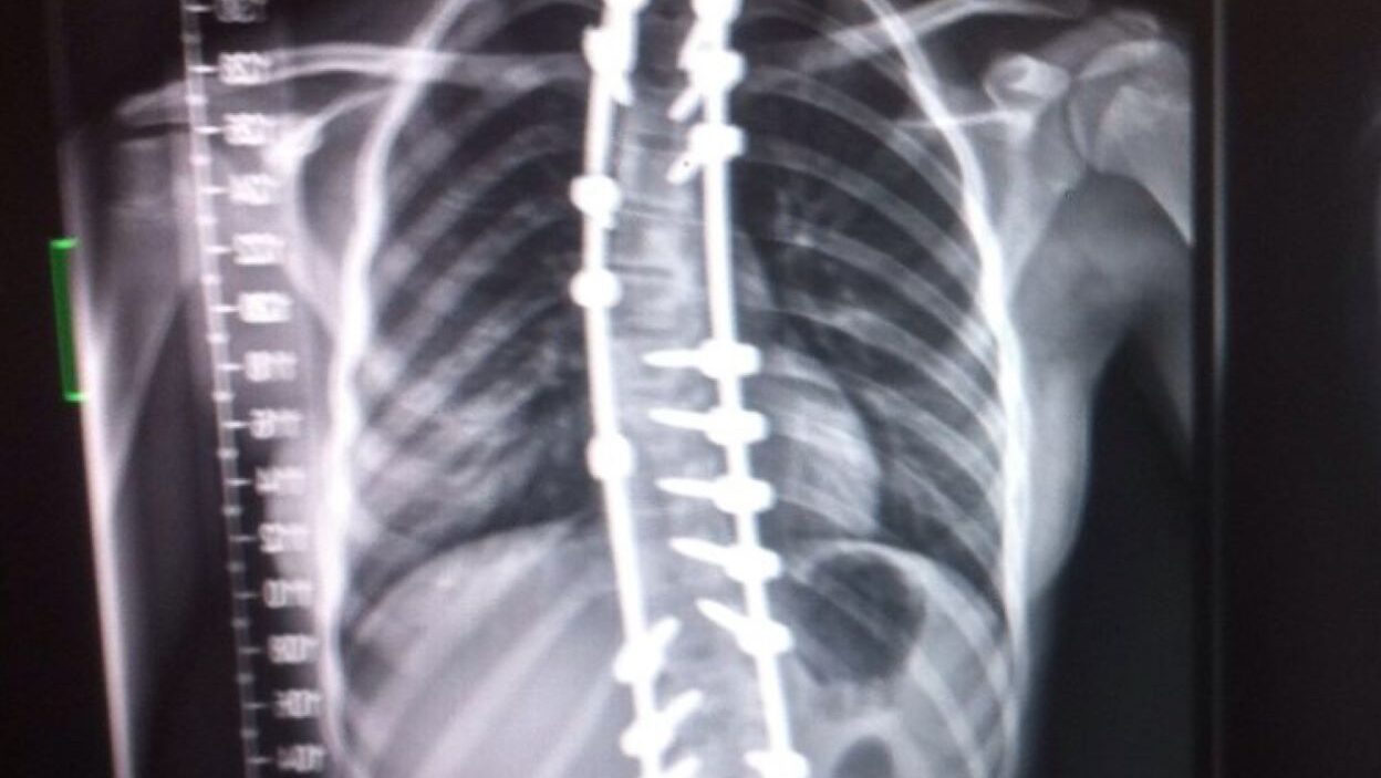 The image shows an x-ray of a spine with pins and clamps in.